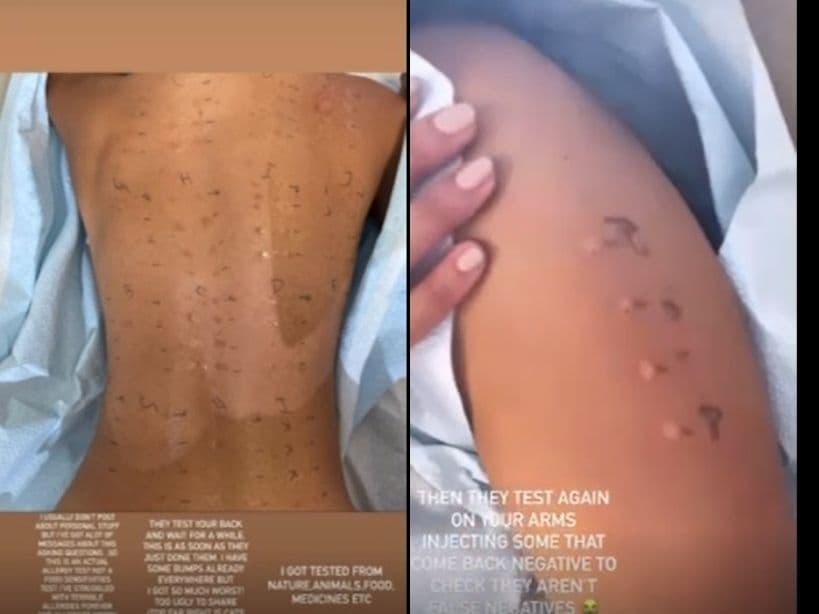 Eiza González habla por primera vez del padecimiento que sufre desde niña y de sus alergias.