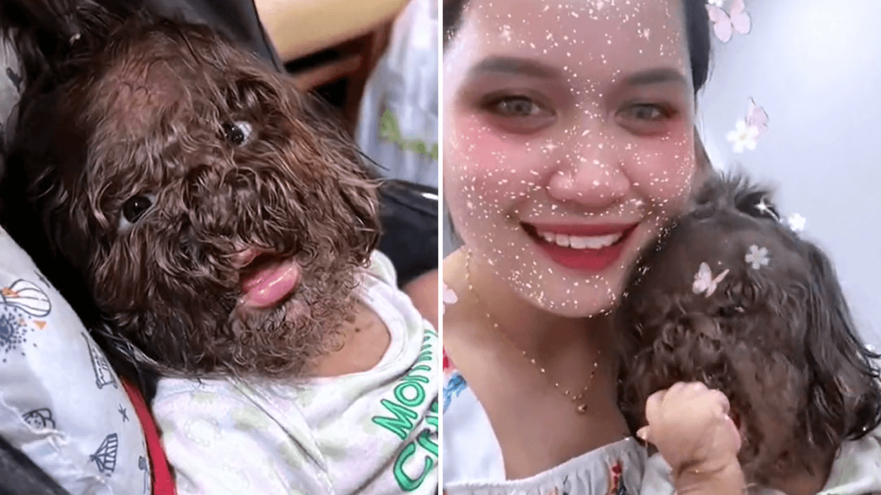 Niña con ‘síndrome de hombre lobo’ conmueve a Internet: conoce a Adik Missclyen y su historia