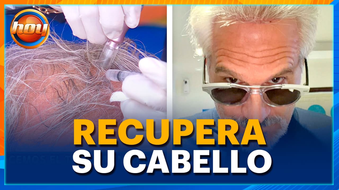 Arath de la Torre muestra EN VIVO su tratamiento de INJERTO CAPILAR