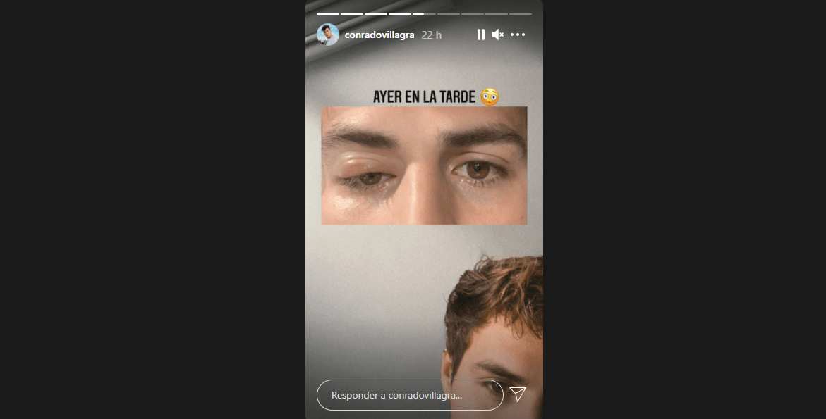 Conrado Villagra mostró que al despertar su ojo estaba completamente hinchado