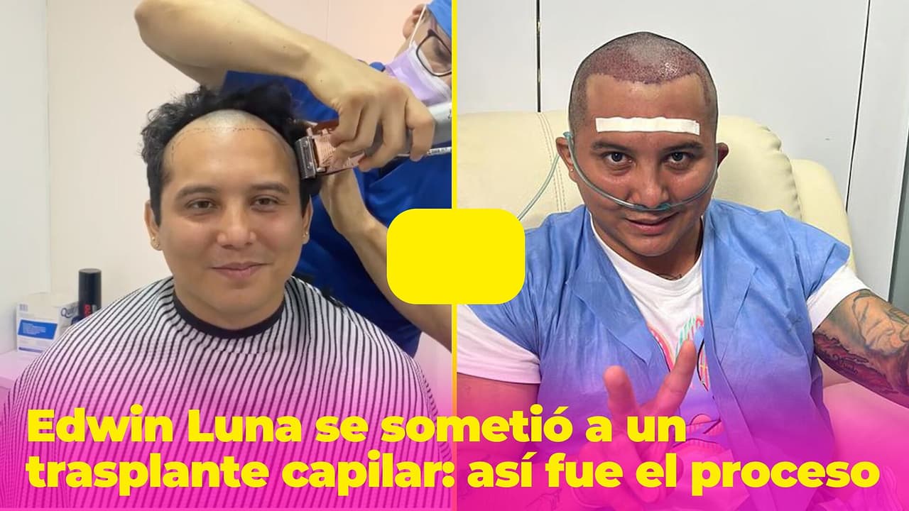 Edwin Luna se sometió a un trasplante capilar porque se "estaba quedando sin tierra en la maceta"