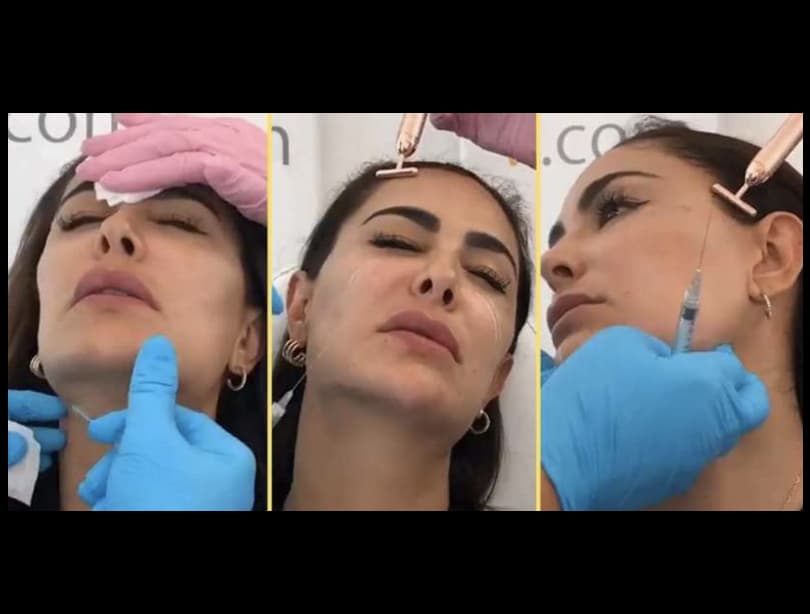 Ninel Conde destapó en redes sociales que de vez en cuando visita al cirujano plástico Garo Kassabian, quien suele aplicarle Toxina Butulínica (Bótox), Gamer Changer y Eyebright. De acuerdo con el experto, el primero remueve las arrugas de la frente y los ojos. El segundo da contorno y esculpe el mentón, mientras que el tercero elimina las bolsas y las ojeras de la cara.