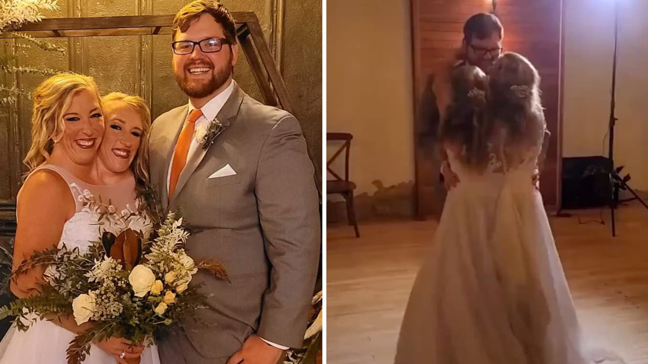 Siamesas revelan cómo viven su vida amorosa al estar unidas: una está casada y otra no 
