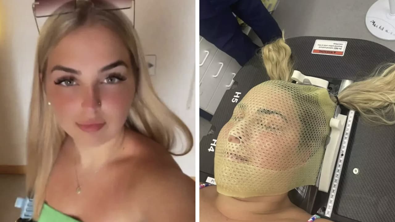 Chica de 19 años confunde resaca con un tumor cerebral: así descubrió su enfermedad