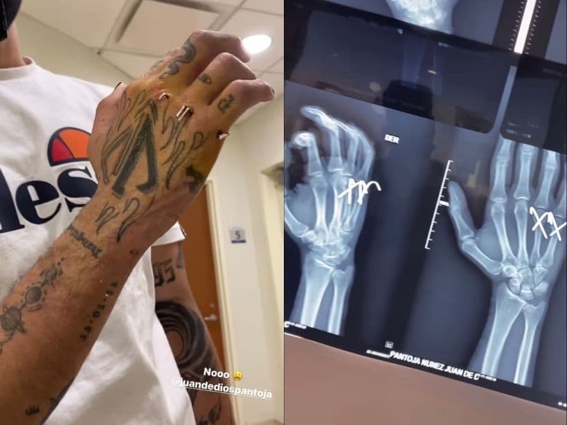 Juan de Dios Pantoja impacta al mostrar los clavos que tiene en su mano.