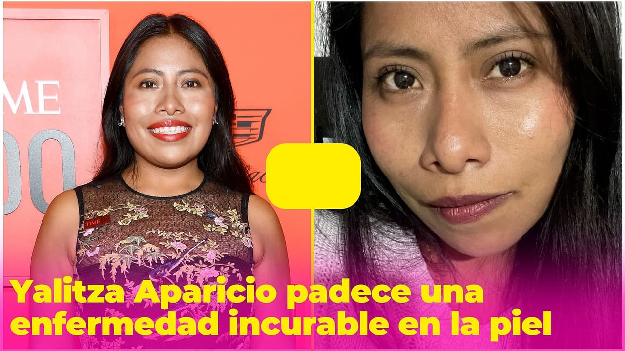 Yalitza Aparicio padece una enfermedad incurable en la piel, así la ha combatido
