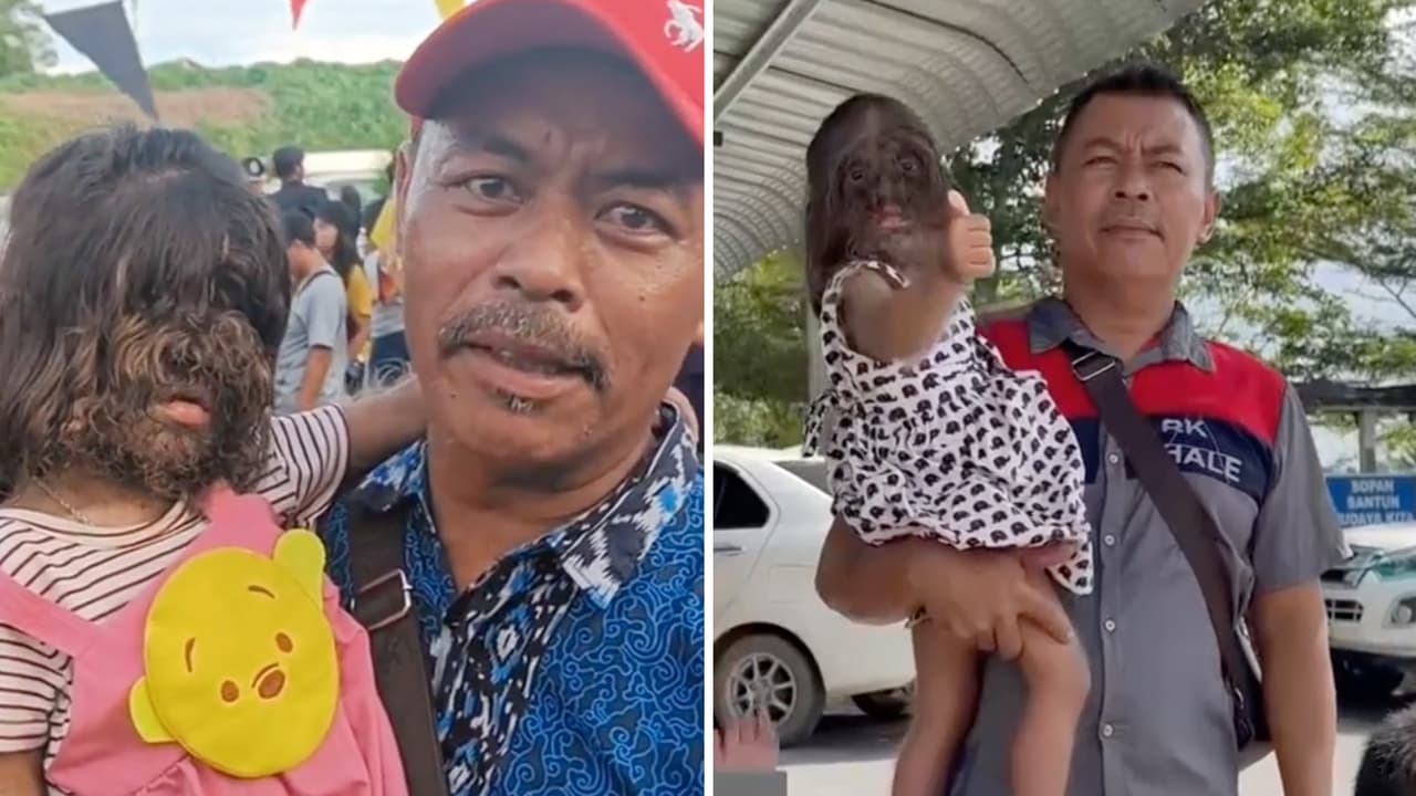 Niña con ‘síndrome de hombre lobo’ conmueve a redes: esta es su impactante historia 