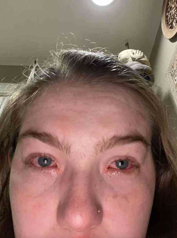 Mujer dice ser alérgica a su novio y causa polémica.