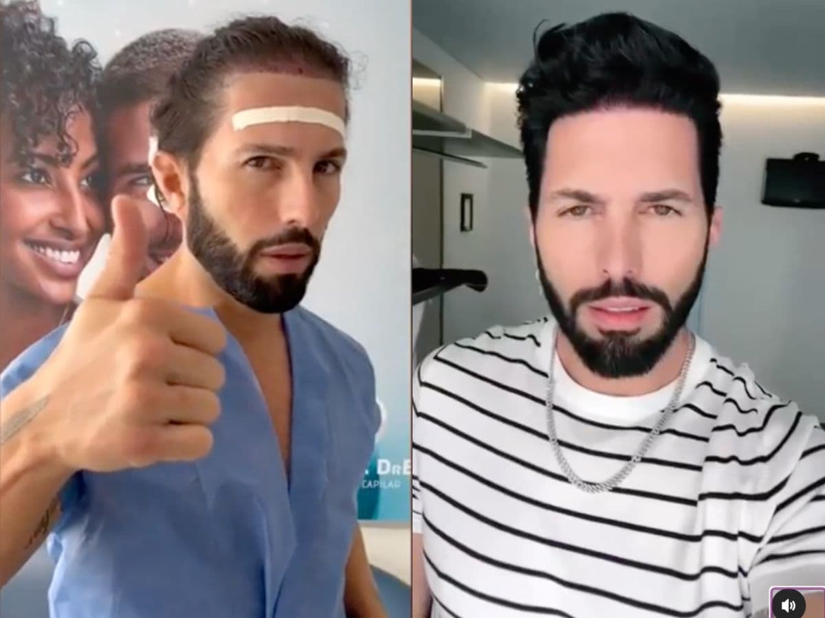 Poncho de Nigris se realizó un injerto de cabello a finales de 2022.