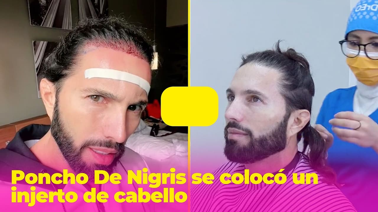 Poncho de Nigris aparece irreconocible tras injerto de cabello y lo comparan con Sebastián Yatra