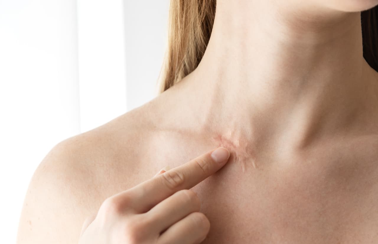 Cicatrices: ¿hay manera de quitarlas desde casa?