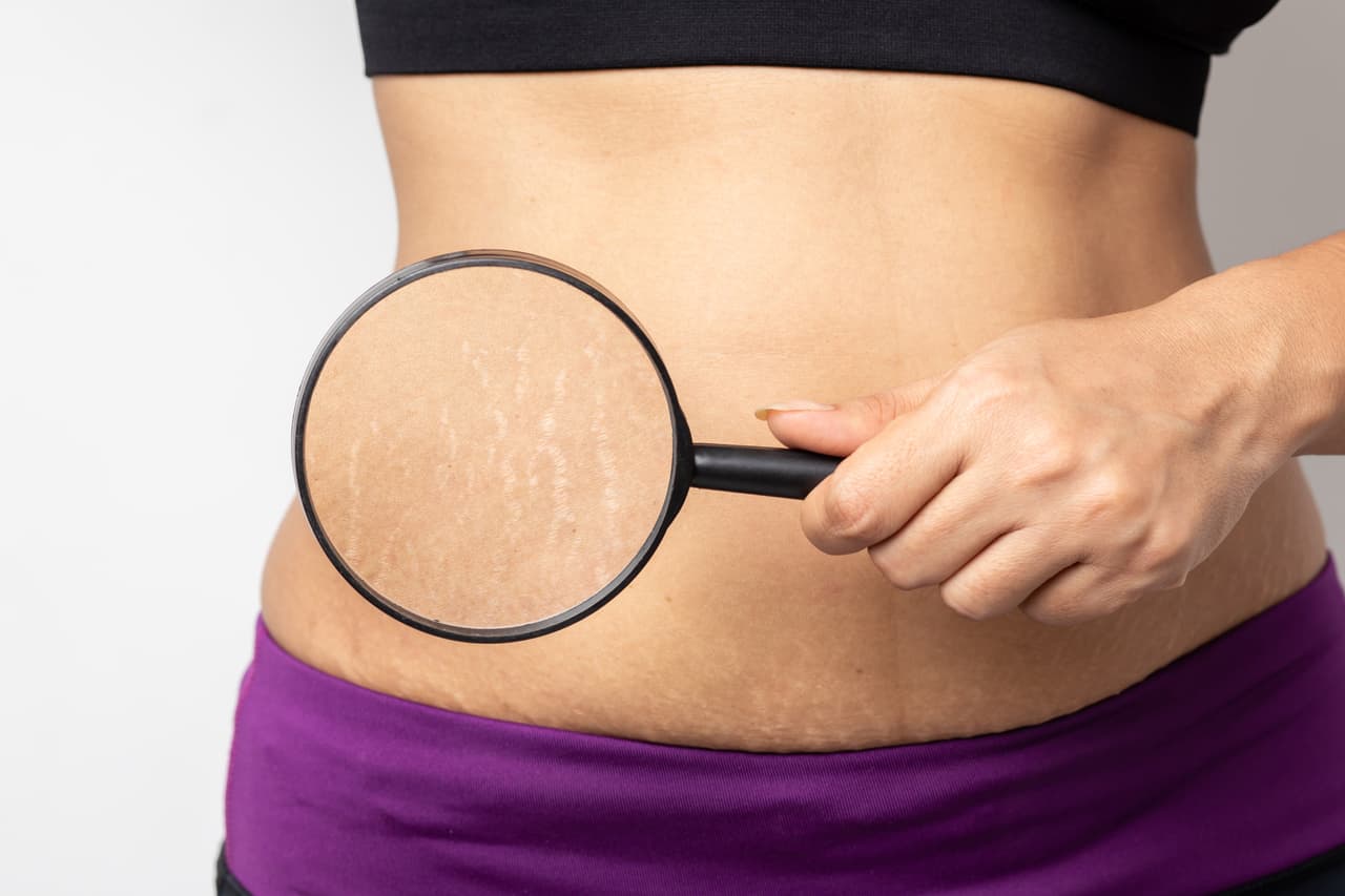 Women Show off the belly after birth. Stretch Marks on white background