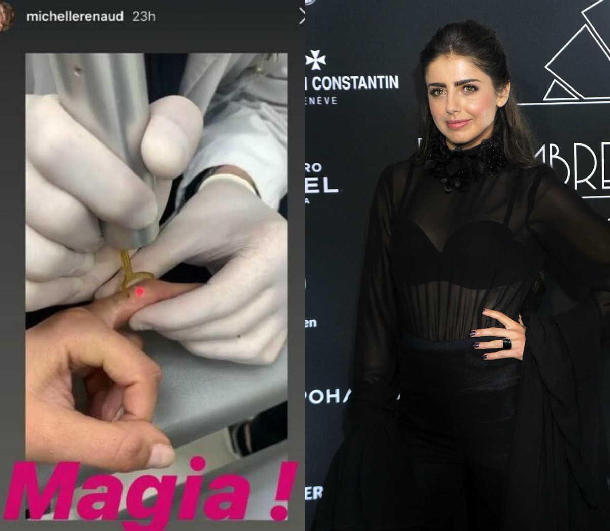 Hace unos días, Michelle Renaud mostró en redes sociales el procedimiento al que se sometió para retirarse tres tatuajes y afirmó que no le dolió, pero que le faltan dos sesiones más para borrarlos por completo. “Apenas va una sesión, se ve horrible esa cosa, pero me dijo el doc que al mes de mi primera sesión se va a caer esa costra y ya se va a ver cómo se quitó la pintura, que son tres sesiones aprox (…) No me dolió, el cambio es abismal”, detalló.
