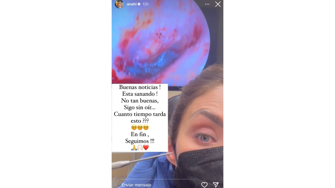 Anahí revela cómo está su oído luego de que le perforaron el tímpano.
