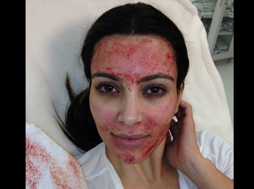 Kim Kardashian se realizó el facial de vampiro en 2013