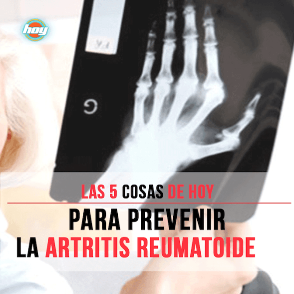 Checa cómo prevenir la artritis reumatoide