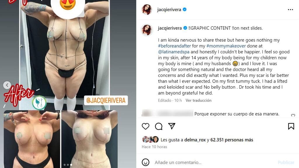 Este es el 'antes y después' definitivo del 'mommy makeover' de Jacqie Rivera.