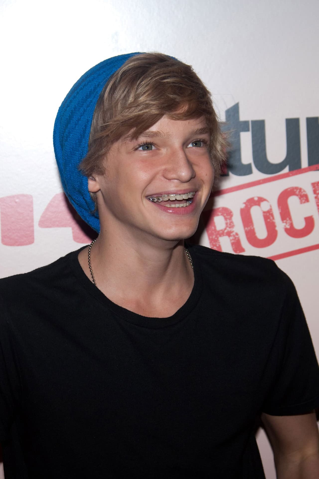 El cantante Cody Simpson utilizó brackets desde que tenía 10 años hasta los 13, admitiendo a Radio Disney que sus dientes se sintieron “libres” cuando se deshizo de los aparatos dentales.
