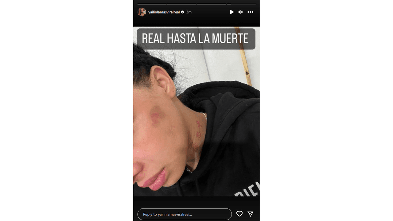 Yailin muestra los presuntos golpes de Anuel