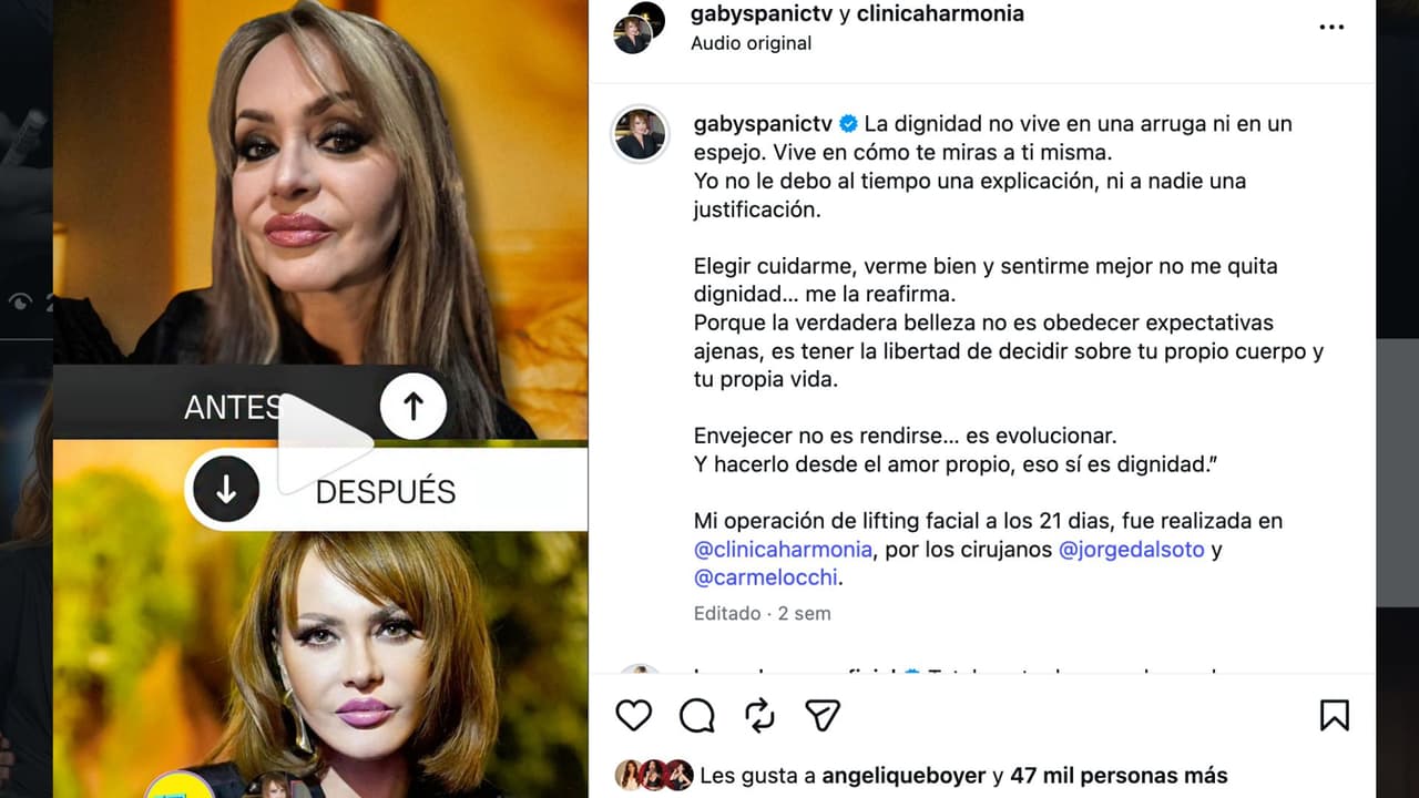 Gaby Spanic muestra el antes y el después de su cirugía en el rostro.