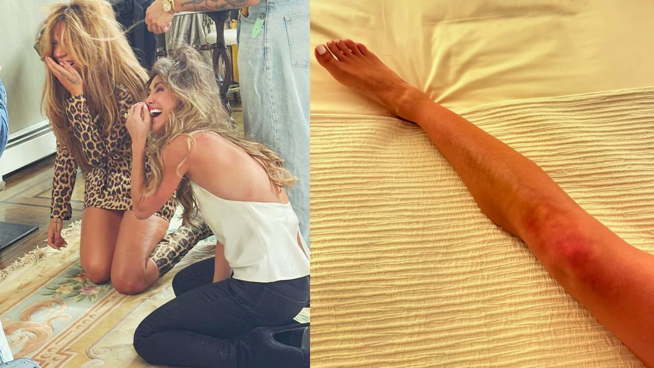 Anahí muestra la lesión que sufrió en la grabación del clip con Karol G