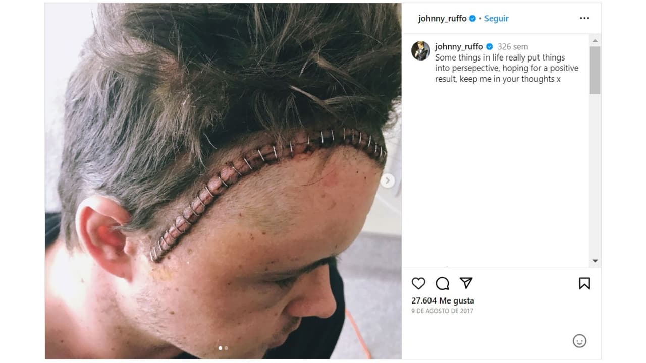 Johnny Ruffo mostró cómo lucía luego de la cirugía en la que le extirparon un tumor.