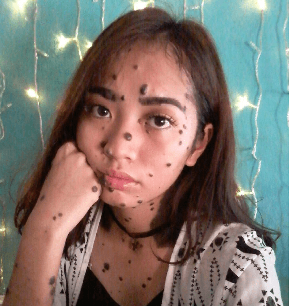 Evita del Mundo, ha hecho un sueño realidad al participar en un certamen local de belleza, representa a Malasya y podría calificar para participar en Miss Universo sin importar las verrugas que habitan en su cuerpo