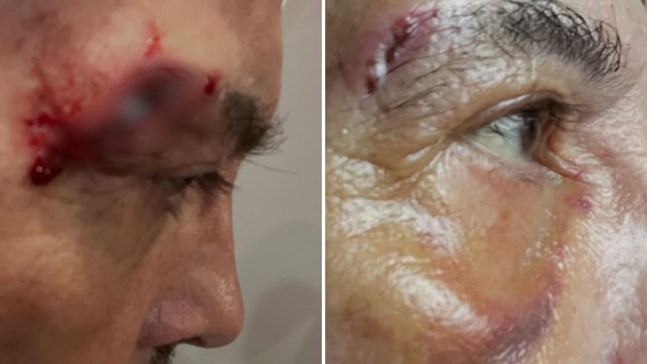 Juan José Origel muestra la lesión que le quedó en el ojo tras caída.