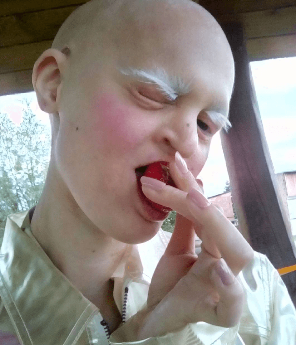 Melanie Gaydos con el padecimiento de displasia ectodérmica, enfermedad que afecta sus huesos, piel y cabello