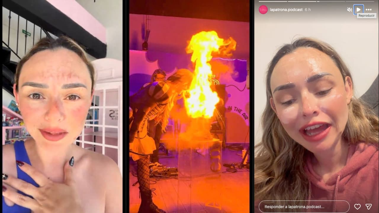 Arlen Hernández relata cómo se quemó la cara tras hacer reto viral