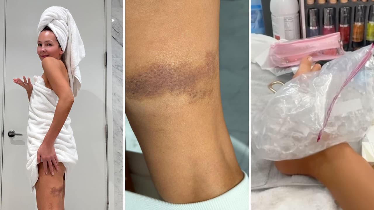 Thalía muestra lesiones tras accidente.