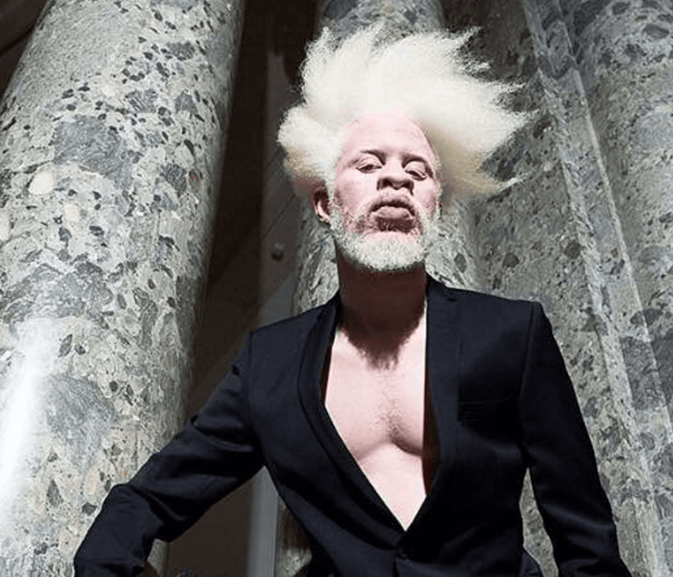 Jewell Jeffrey con su mezcla de belleza albina de raza negra