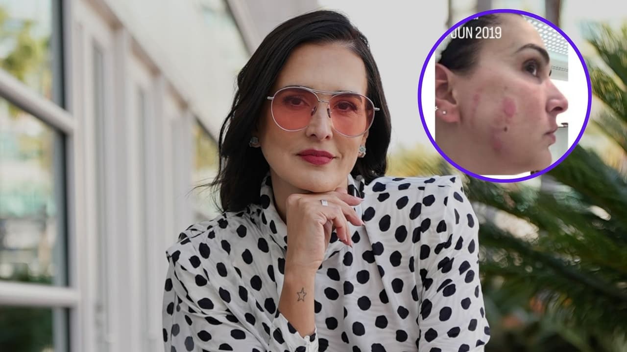 Influencer y modelo muestra las heridas en su rostro tras someterse a un tratamiento estético