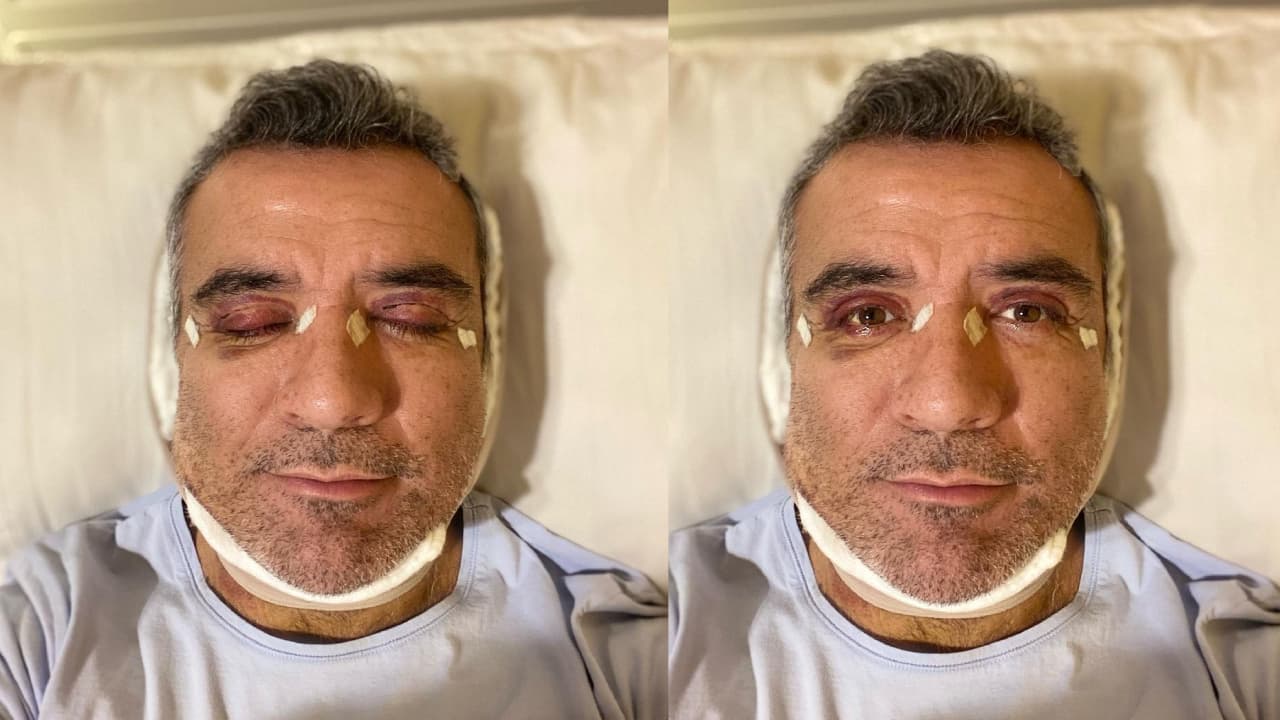 Héctor Sandarti se somete a cirugía plástica y muestra el resultado