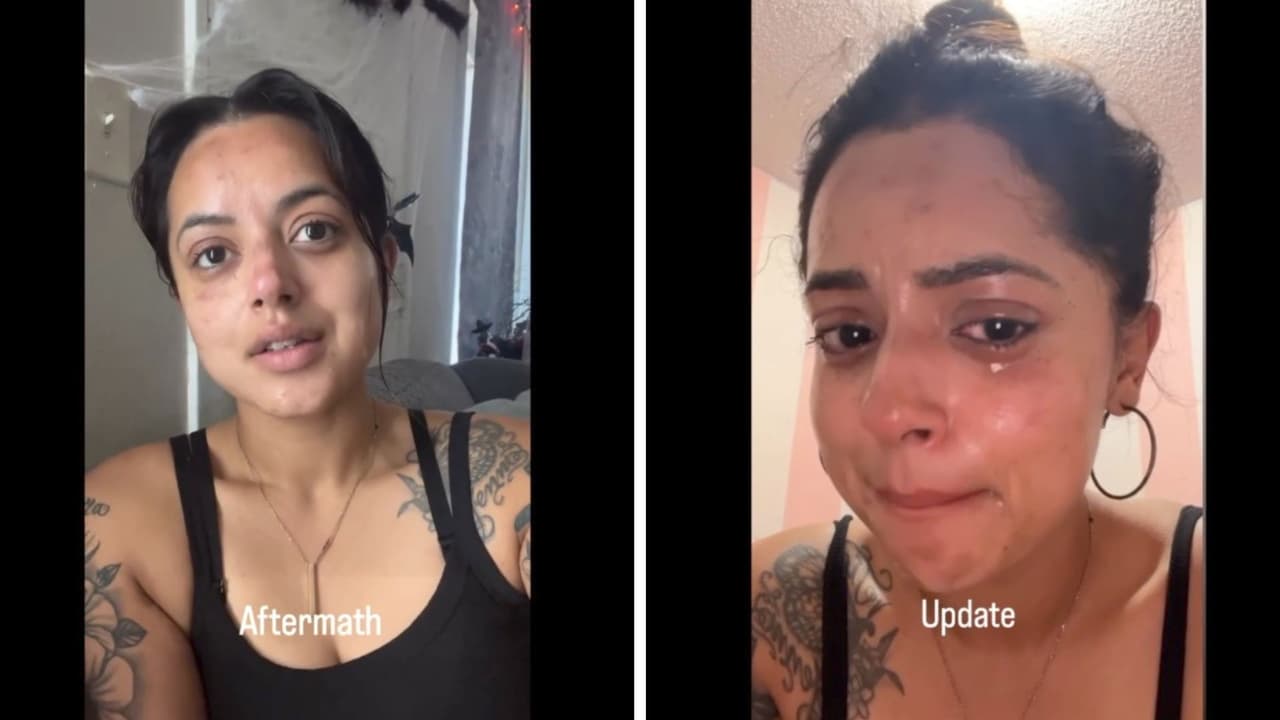 Abigail, la hija de Lupillo Rivera, compartió con sus seguidores las consecuencias de su accidente