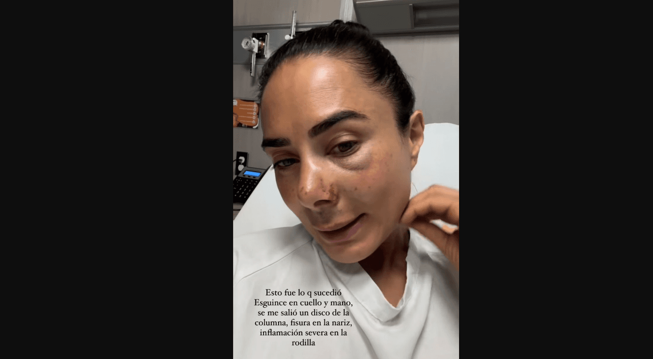 Actriz de telenovelas sufre accidente y reaparece casi desfigurada