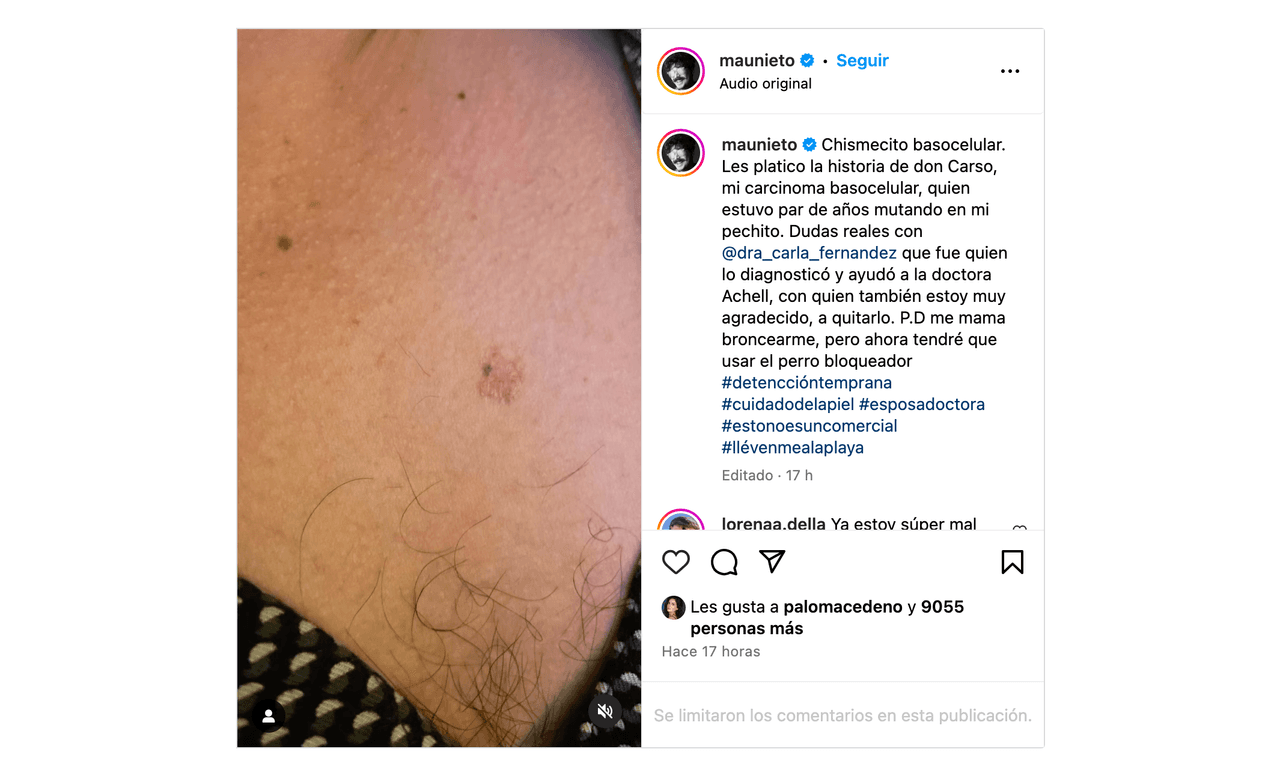 Mau Nieto de Me caigo de risa reveló cómo descubrió que tiene cáncer de piel