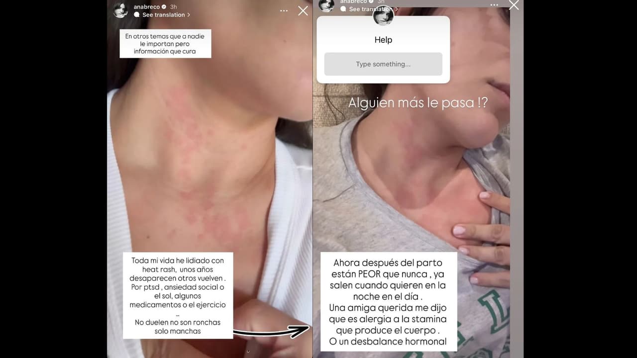 Ana Brenda Contreras se sincera en Instagram sobre el problema que padece en la piel