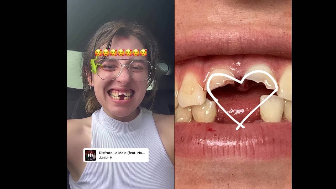 Regina Castro, hija de Angélica Rivera muestra que quedó chimuela tras accidente