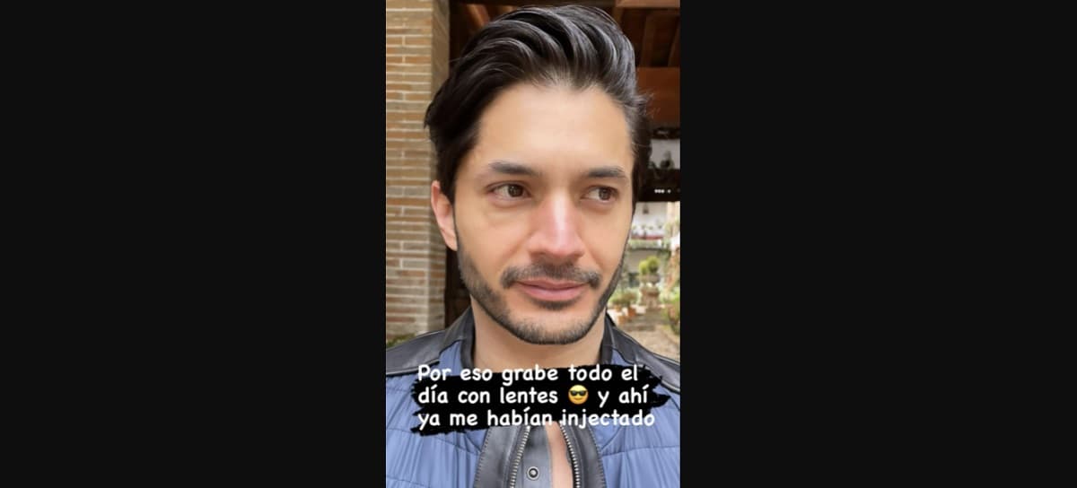 Daniel Elbittar se reincorporó a sus actividades pese a la hinchazón de su rostro