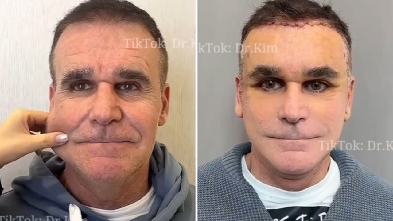 Cirugías plásticas chinas causan impacto y terror en TikTok por cambios extremos: ¿parecen robots?