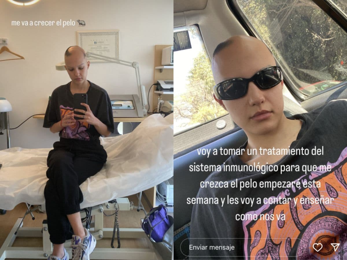La novia de Camila Araiza se sinceró sobre su lucha contra la alopecia.