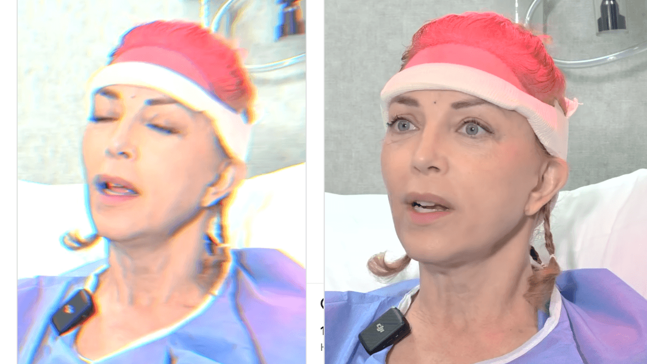 Laura Flores se somete a trasplante de cabello tras polémica con Lalo Salazar: hace tajante confesión