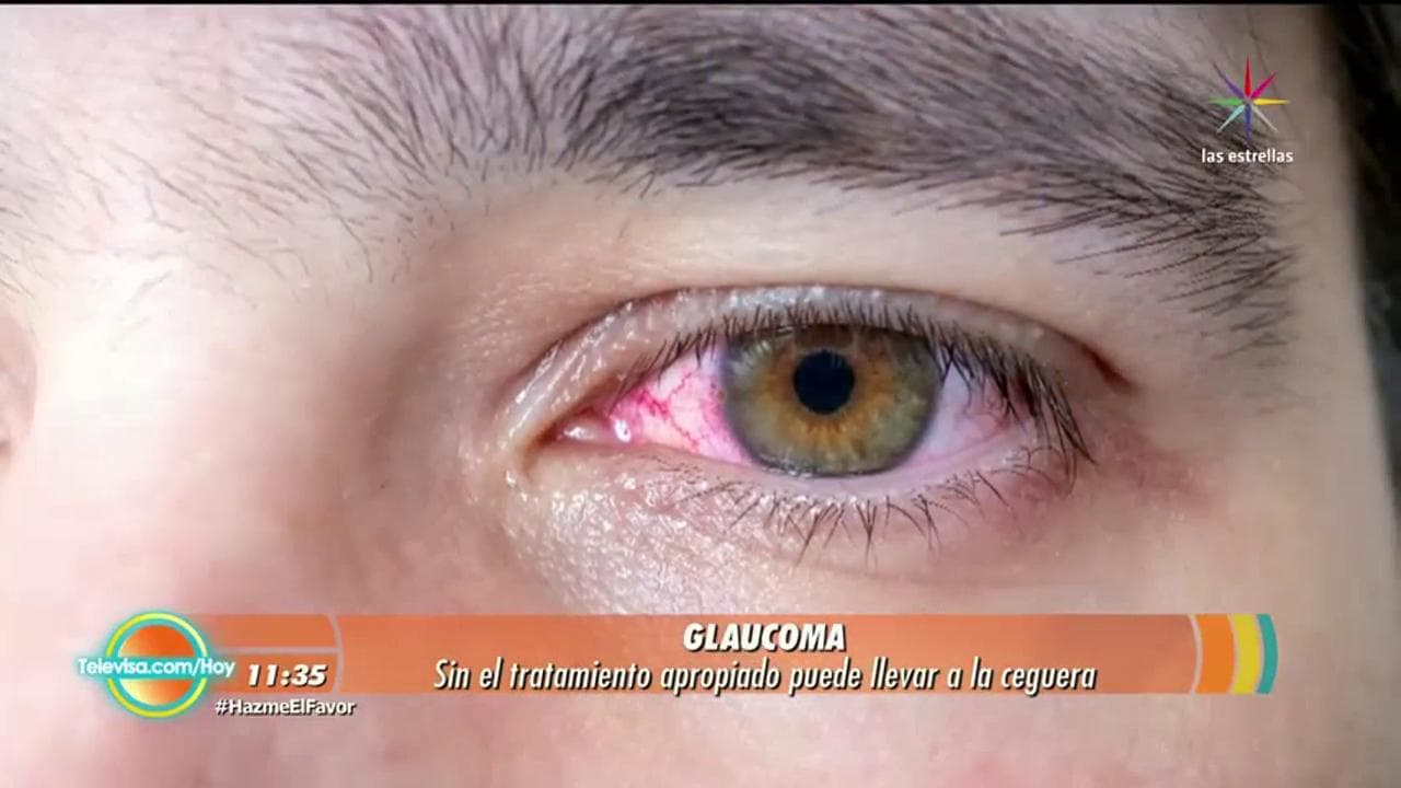 LOS DOCTORES EN HOY: Glaucoma