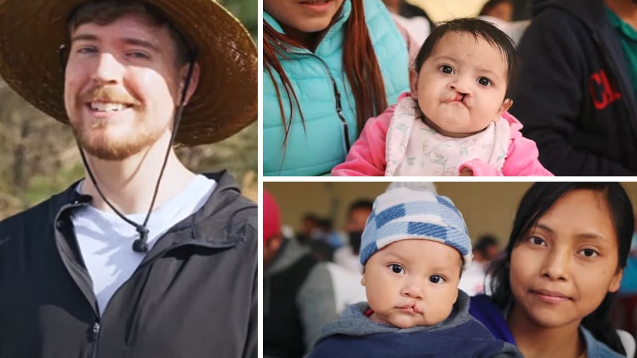 Mr. Beast regala más de 100 cirugías a niños con labio leporino