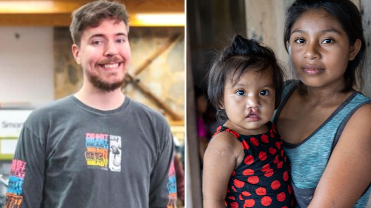 Mr. Beast regala más de 100 cirugías a niños con labio leporino y lo llaman 'héroe sin capa'