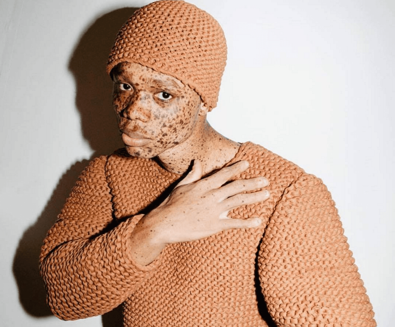 Ralph Souffrant ha declarado que en su infancia fue víctima de bullying, hoy sus pecas lo han catapultado a la fama