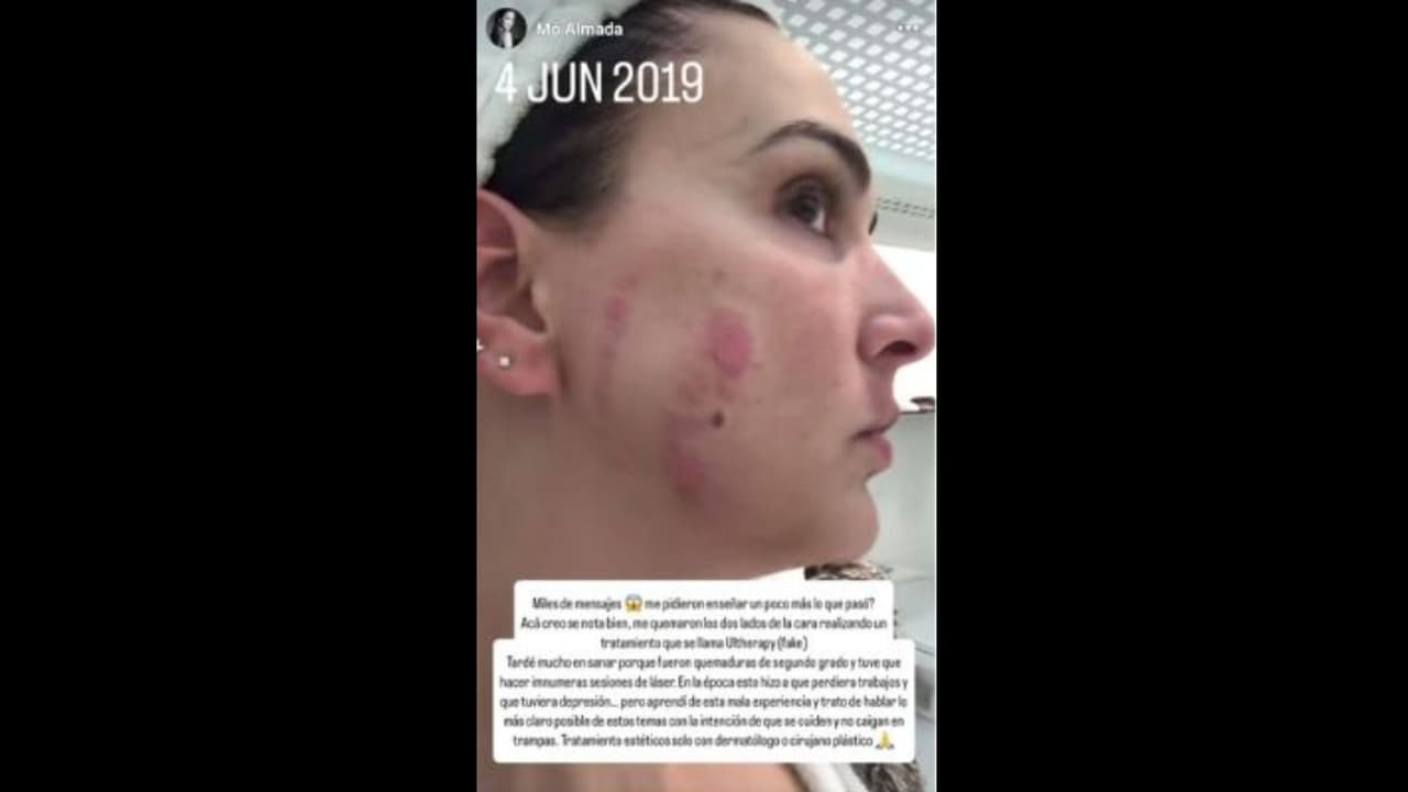 Mô Almada muestra las quemaduras que sufrió tras someterse a un tratamiento estético