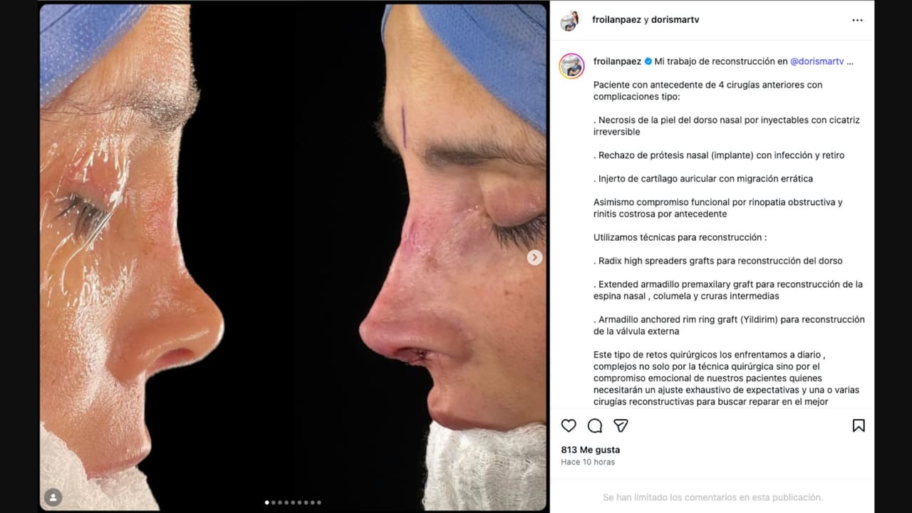 Dorismar se somete a nueva cirugía recostructiva con un nuevo cirujano plástico