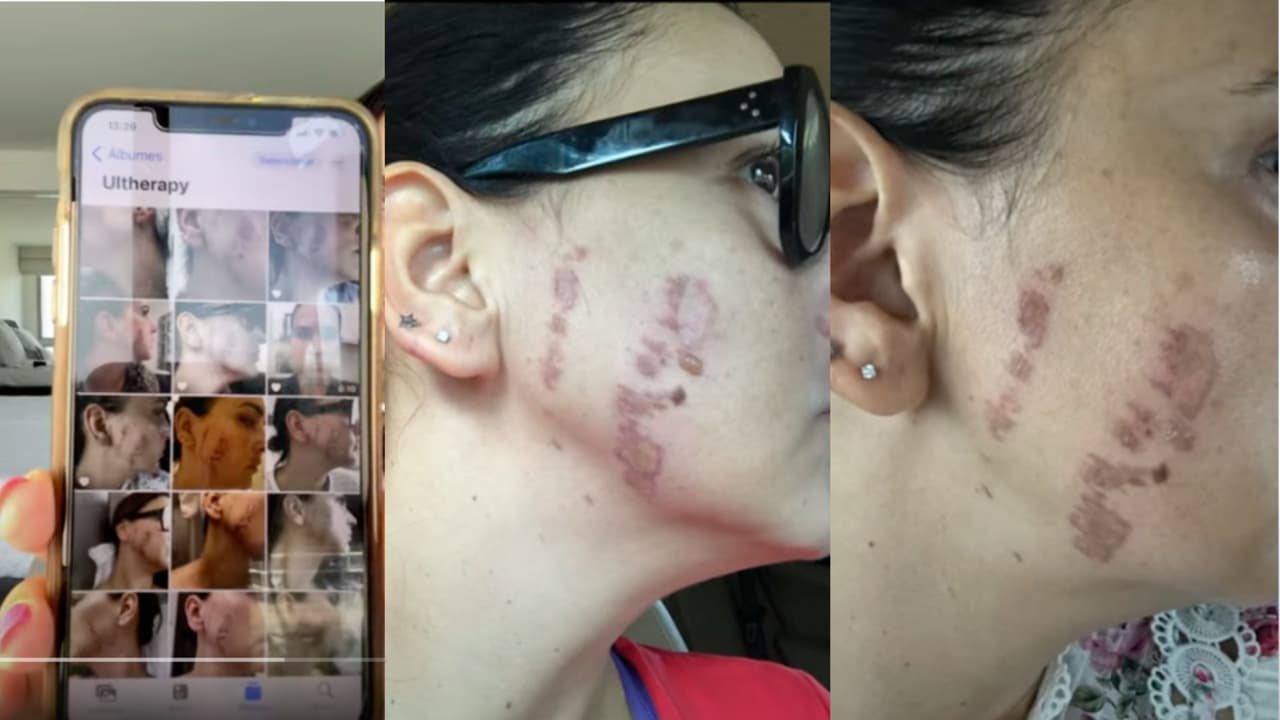 Mô Almada muestra las quemaduras que sufrió tras someterse a un tratamiento estético